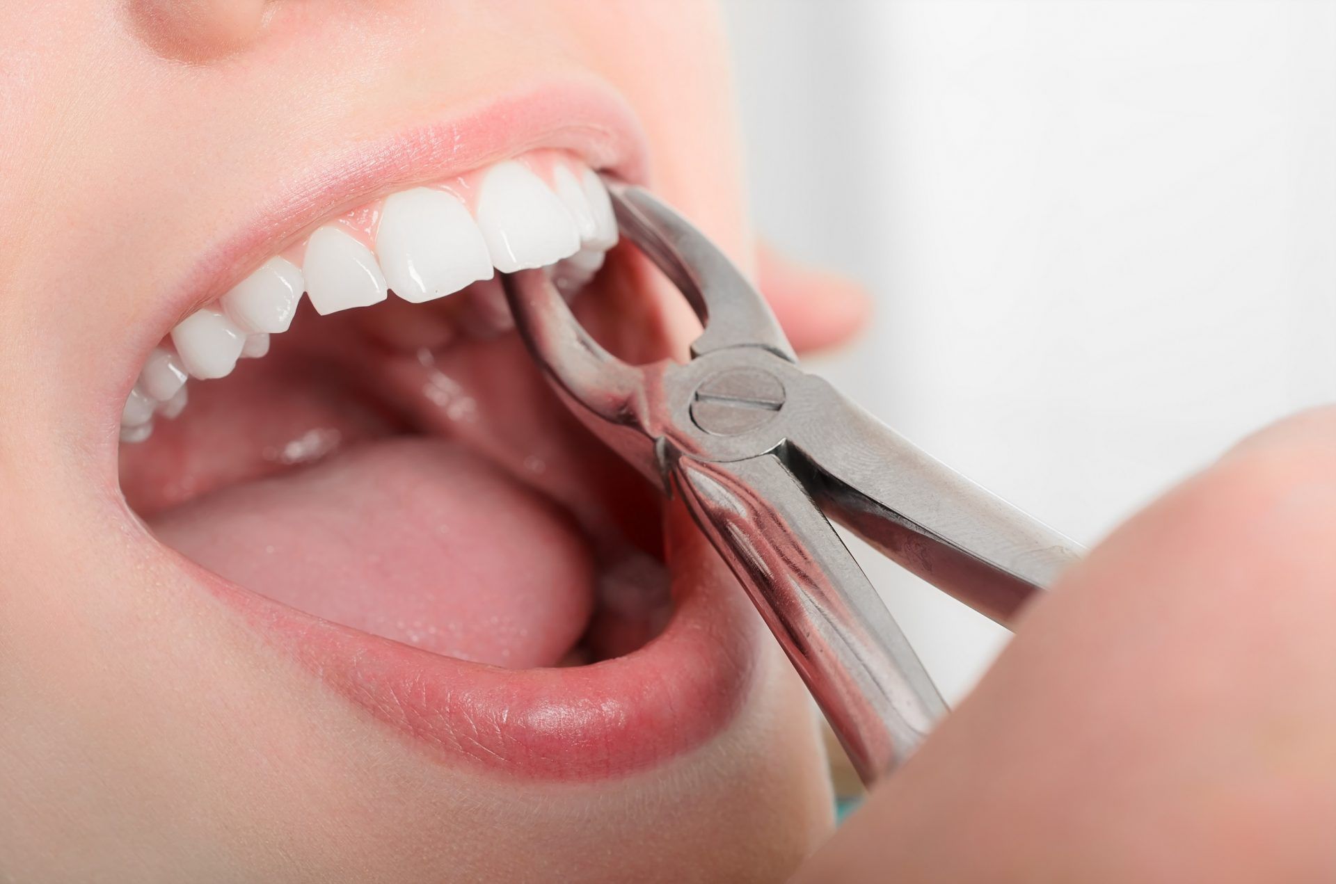 Удаление зубов: когда сохранение зуба невозможно