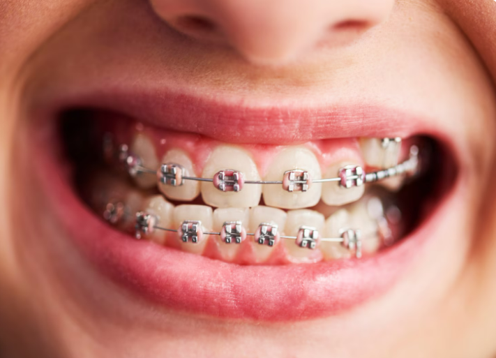 Установка брекетов: краткий гид по современным методам исправления прикуса, уходу за зубами и жизни с ортодонтической системой